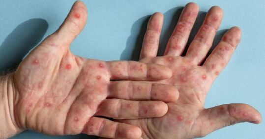 Update on the mpox outbreak – what nurses in the community need to know