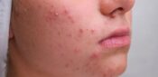Top tips for supporting patients with acne  