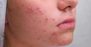 Tips to support patients with acne