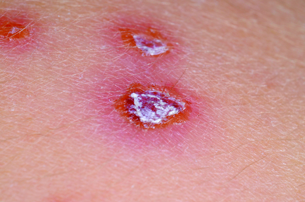 Chickenpox symptoms, treatment and vulnerable groups | Nursing in Practice